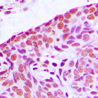 MAP3K3 / MEKK3 Antibody - Immunohistochemical analysis of MEKK3 staining in human breast cancer formalin fixed paraffin embedded tissue section. The section was pre-treated using heat mediated antigen retrieval with sodium citrate buffer (pH 6.0). The section was then incubated with the antibody at room temperature and detected using an HRP conjugated compact polymer system. DAB was used as the chromogen. The section was then counterstained with hematoxylin and mounted with DPX.