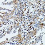 MAP3K3 / MEKK3 Antibody - Immunohistochemistry of paraffin-embedded Human lung cancer using MAP3K3 Polyclonal Antibody at dilution of 1:100 (40x lens).