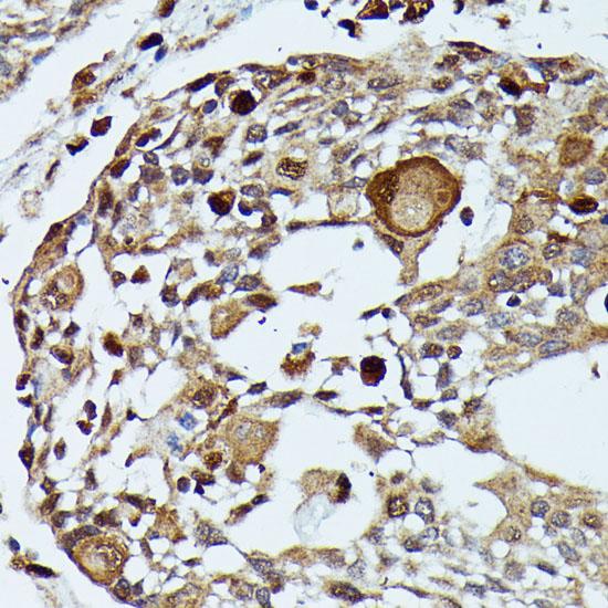 MAP3K3 / MEKK3 Antibody - Immunohistochemistry of paraffin-embedded Human esophageal cancer using MAP3K3 Polyclonal Antibody at dilution of 1:100 (40x lens).