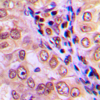 MAP3K4 / MEKK4 Antibody - Immunohistochemical analysis of MEKK4 staining in human breast cancer formalin fixed paraffin embedded tissue section. The section was pre-treated using heat mediated antigen retrieval with sodium citrate buffer (pH 6.0). The section was then incubated with the antibody at room temperature and detected using an HRP conjugated compact polymer system. DAB was used as the chromogen. The section was then counterstained with hematoxylin and mounted with DPX.