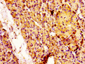 MAP3K4 / MEKK4 Antibody - Immunohistochemistry image at a dilution of 1:100 and staining in paraffin-embedded human pancreatic tissue performed on a Leica BondTM system. After dewaxing and hydration, antigen retrieval was mediated by high pressure in a citrate buffer (pH 6.0) . Section was blocked with 10% normal goat serum 30min at RT. Then primary antibody (1% BSA) was incubated at 4 °C overnight. The primary is detected by a biotinylated secondary antibody and visualized using an HRP conjugated SP system.
