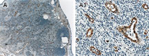 MAP3K5 / ASK1 Antibody - Formalin-fixed paraffin-embedded tissue section of human reactive tonsil stained for ASK1 expression using Polyclonal Antibody to ASK1 at 1:2000. A and A1. Low and high magnification, respectively. ASK1 expression was seen in the vasculature (endothelial cells). Hematoxylin-Eosin counterstain.
