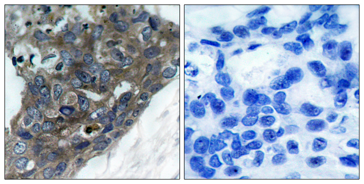 MAP3K5 / ASK1 Antibody - Immunohistochemistry analysis of paraffin-embedded human breast carcinoma tissue, using ASK1 Antibody. The picture on the right is blocked with the synthesized peptide.