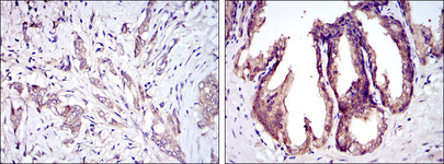 MAP3K5 / ASK1 Antibody - IHC of paraffin-embedded breast cancer tissues (left) and prostate tissues (right) using MAP3K5 mouse monoclonal antibody with DAB staining.
