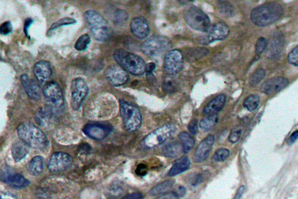 MAP3K5 / ASK1 Antibody - IHC of ASK1 (E960) pAb in paraffin-embedded human breast carcinoma tissue.