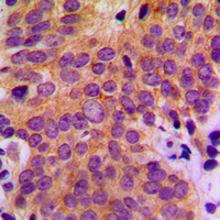 MAP3K5 / ASK1 Antibody - Immunohistochemical analysis of ASK1 staining in human breast cancer formalin fixed paraffin embedded tissue section. The section was pre-treated using heat mediated antigen retrieval with sodium citrate buffer (pH 6.0). The section was then incubated with the antibody at room temperature and detected using an HRP conjugated compact polymer system. DAB was used as the chromogen. The section was then counterstained with hematoxylin and mounted with DPX.