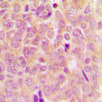 MAP3K5 / ASK1 Antibody - Immunohistochemical analysis of ASK1 (pS83) staining in human breast cancer formalin fixed paraffin embedded tissue section. The section was pre-treated using heat mediated antigen retrieval with sodium citrate buffer (pH 6.0). The section was then incubated with the antibody at room temperature and detected using an HRP conjugated compact polymer system. DAB was used as the chromogen. The section was then counterstained with hematoxylin and mounted with DPX.