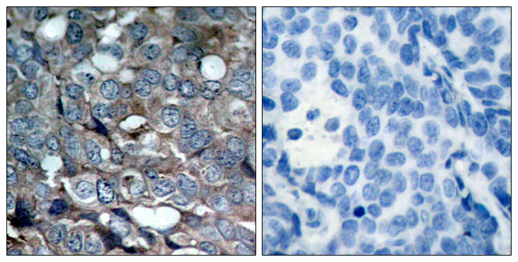 MAP3K5 / ASK1 Antibody - Immunohistochemistry analysis of paraffin-embedded human breast carcinoma, using ASK1 (Phospho-Ser83) Antibody. The picture on the right is blocked with the phospho peptide.