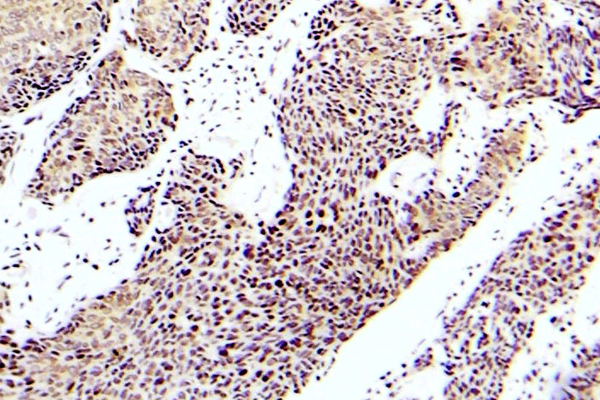 MAP3K5 / ASK1 Antibody - IHC of p-ASK1 (S83) pAb in paraffin-embedded human lung adenocarcinoma tissue.