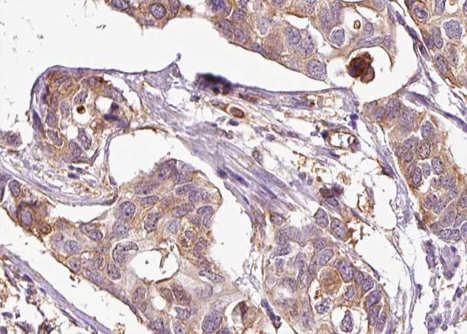 MAP3K5 / ASK1 Antibody - 1:100 staining human breast carcinoma tissue by IHC-P. The tissue was formaldehyde fixed and a heat mediated antigen retrieval step in citrate buffer was performed. The tissue was then blocked and incubated with the antibody for 1.5 hours at 22°C. An HRP conjugated goat anti-rabbit antibody was used as the secondary.