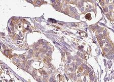 MAP3K5 / ASK1 Antibody - 1:100 staining human breast carcinoma tissue by IHC-P. The tissue was formaldehyde fixed and a heat mediated antigen retrieval step in citrate buffer was performed. The tissue was then blocked and incubated with the antibody for 1.5 hours at 22°C. An HRP conjugated goat anti-rabbit antibody was used as the secondary.