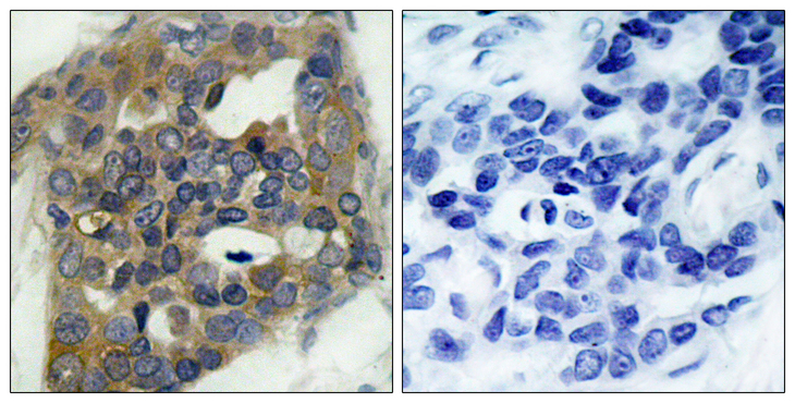 MAP3K5 / ASK1 Antibody - Immunohistochemistry analysis of paraffin-embedded human breast carcinoma, using ASK1 (Phospho-Ser966) Antibody. The picture on the right is blocked with the phospho peptide.