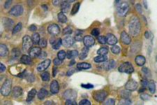 MAP3K5 / ASK1 Antibody - IHC of p-ASK1 (S966)pAb in paraffin-embedded human breast carcinoma tissue.