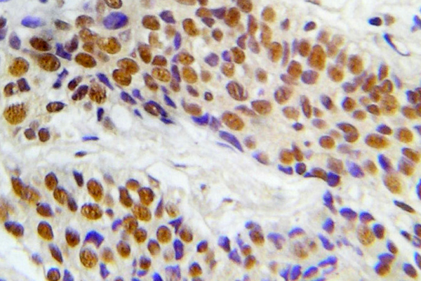 MAP3K5 / ASK1 Antibody - IHC of p-ASK1 (S966) pAb in paraffin-embedded human lung adenocarcinoma tissue.