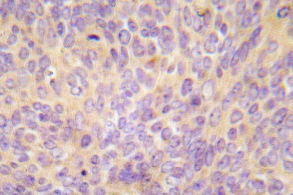 MAP3K5 / ASK1 Antibody - IHC of ASK1 (V972) pAb in paraffin-embedded human lung adenocarcinoma tissue.