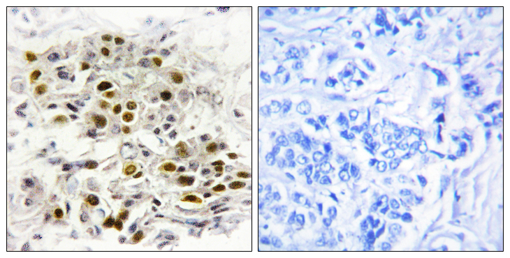 MAP3K6 / MEKK6 Antibody - Immunohistochemistry analysis of paraffin-embedded human breast carcinoma tissue, using MAP3K6 Antibody. The picture on the right is blocked with the synthesized peptide.