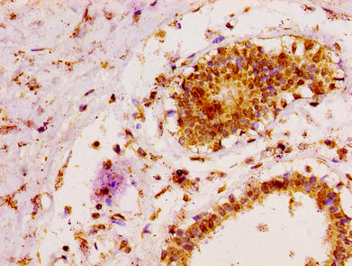 MAP3K6 / MEKK6 Antibody - Immunohistochemistry image at a dilution of 1:100 and staining in paraffin-embedded human breast cancer performed on a Leica BondTM system. After dewaxing and hydration, antigen retrieval was mediated by high pressure in a citrate buffer (pH 6.0) . Section was blocked with 10% normal goat serum 30min at RT. Then primary antibody (1% BSA) was incubated at 4 °C overnight. The primary is detected by a biotinylated secondary antibody and visualized using an HRP conjugated SP system.