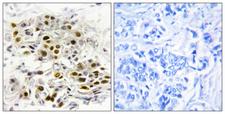 MAP3K6 / MEKK6 Antibody - Peptide - + Immunohistochemistry analysis of paraffin-embedded human breast carcinoma tissue, using MAP3K6 antibody.