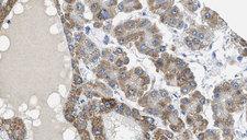 MAP3K7 / TAK1 Antibody - 1:100 staining human liver carcinoma tissues by IHC-P. The sample was formaldehyde fixed and a heat mediated antigen retrieval step in citrate buffer was performed. The sample was then blocked and incubated with the antibody for 1.5 hours at 22°C. An HRP conjugated goat anti-rabbit antibody was used as the secondary.