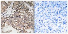 MAP3K7 / TAK1 Antibody - Peptide - + Immunohistochemistry analysis of paraffin-embedded human breast carcinoma tissue using MAP3K7 (Ab-187) antibody.