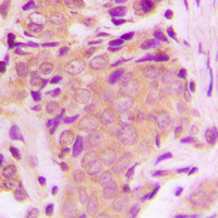 MAP3K7 / TAK1 Antibody - Immunohistochemical analysis of TAK1 (pT184) staining in human breast cancer formalin fixed paraffin embedded tissue section. The section was pre-treated using heat mediated antigen retrieval with sodium citrate buffer (pH 6.0). The section was then incubated with the antibody at room temperature and detected using an HRP conjugated compact polymer system. DAB was used as the chromogen. The section was then counterstained with hematoxylin and mounted with DPX.