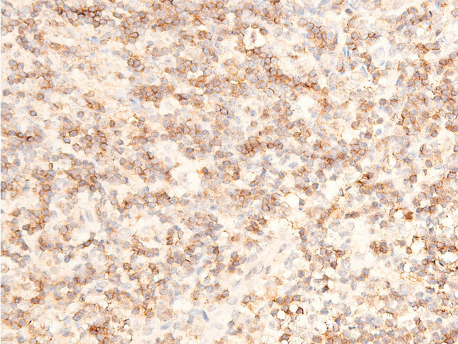 MAP3K7 / TAK1 Antibody - 1:100 staining human appendix tissue by IHC-P. The tissue was formaldehyde fixed and a heat mediated antigen retrieval step in citrate buffer was performed. The tissue was then blocked and incubated with the antibody for 1.5 hours at 22°C. An HRP conjugated goat anti-rabbit antibody was used as the secondary.