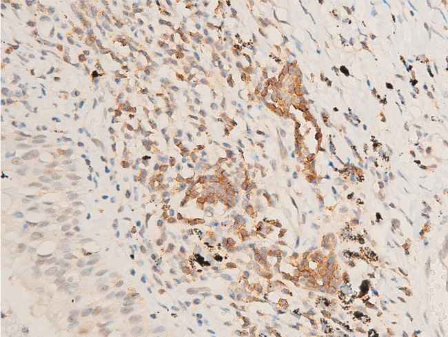 MAP3K7 / TAK1 Antibody - 1:100 staining human TB tissue by IHC-P. The tissue was formaldehyde fixed and a heat mediated antigen retrieval step in citrate buffer was performed. The tissue was then blocked and incubated with the antibody for 1.5 hours at 22°C. An HRP conjugated goat anti-rabbit antibody was used as the secondary.