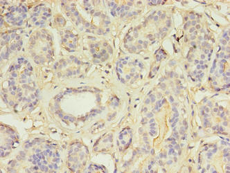 MAP3K7CL / TAK1L Antibody - Immunohistochemistry of paraffin-embedded human breast cancer using MAP3K7CL Antibody at dilution of 1:100