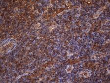 MAP3K8 / TPL2 Antibody - Immunohistochemical staining of paraffin-embedded Carcinoma of Human lung tissue using anti-MAP3K8 mouse monoclonal antibody. (Heat-induced epitope retrieval by 1mM EDTA in 10mM Tris buffer. (pH8.5) at 120°C for 3 min. (1:150)