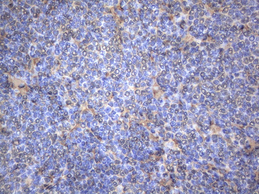 MAP3K8 / TPL2 Antibody - Immunohistochemical staining of paraffin-embedded Human lymphoma tissue using anti-MAP3K8 mouse monoclonal antibody. (Heat-induced epitope retrieval by 1mM EDTA in 10mM Tris buffer. (pH8.5) at 120°C for 3 min. (1:150)