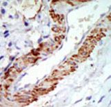 MAP3K8 / TPL2 Antibody - Formalin-fixed and paraffin-embedded human cancer tissue reacted with the primary antibody, which was peroxidase-conjugated to the secondary antibody, followed by DAB staining. This data demonstrates the use of this antibody for immunohistochemistry; clinical relevance has not been evaluated. BC = breast carcinoma; HC = hepatocarcinoma.