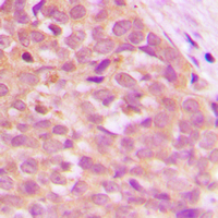MAP3K8 / TPL2 Antibody - Immunohistochemical analysis of TPL2 staining in human breast cancer formalin fixed paraffin embedded tissue section. The section was pre-treated using heat mediated antigen retrieval with sodium citrate buffer (pH 6.0). The section was then incubated with the antibody at room temperature and detected using an HRP conjugated compact polymer system. DAB was used as the chromogen. The section was then counterstained with hematoxylin and mounted with DPX.