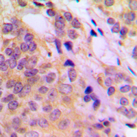 MAP3K8 / TPL2 Antibody - Immunohistochemical analysis of TPL2 (pT290) staining in human breast cancer formalin fixed paraffin embedded tissue section. The section was pre-treated using heat mediated antigen retrieval with sodium citrate buffer (pH 6.0). The section was then incubated with the antibody at room temperature and detected using an HRP conjugated compact polymer system. DAB was used as the chromogen. The section was then counterstained with hematoxylin and mounted with DPX.