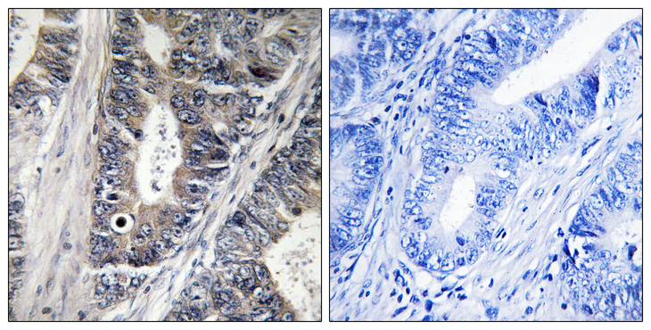 MAP3K9 / MLK1 Antibody - Immunohistochemistry analysis of paraffin-embedded human colon carcinoma tissue, using MAP3K9 Antibody. The picture on the right is blocked with the synthesized peptide.