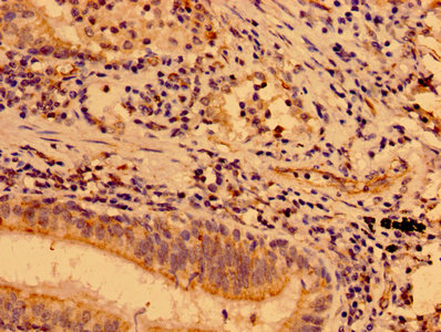MAP3K9 / MLK1 Antibody - Immunohistochemistry image of paraffin-embedded human lung cancer at a dilution of 1:100