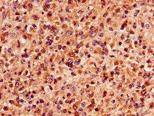 MAP4 Antibody - Immunohistochemistry of paraffin-embedded human glioma cancer using MAP4 Antibody at dilution of 1:100