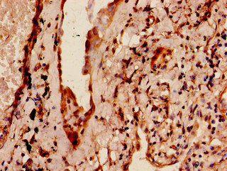 MAP4 Antibody - Immunohistochemistry of paraffin-embedded human lung cancer using MAP4 Antibody at dilution of 1:100