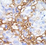 MAP4K1 / HPK1 Antibody - Formalin-fixed and paraffin-embedded human cancer tissue reacted with the primary antibody, which was peroxidase-conjugated to the secondary antibody, followed by DAB staining. This data demonstrates the use of this antibody for immunohistochemistry; clinical relevance has not been evaluated. BC = breast carcinoma; HC = hepatocarcinoma.