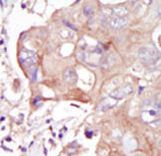 MAP4K3 / GLK Antibody - Formalin-fixed and paraffin-embedded human cancer tissue reacted with the primary antibody, which was peroxidase-conjugated to the secondary antibody, followed by DAB staining. This data demonstrates the use of this antibody for immunohistochemistry; clinical relevance has not been evaluated. BC = breast carcinoma; HC = hepatocarcinoma.