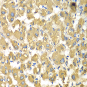 MAP4K3 / GLK Antibody - Immunohistochemistry of paraffin-embedded human liver injury tissue.