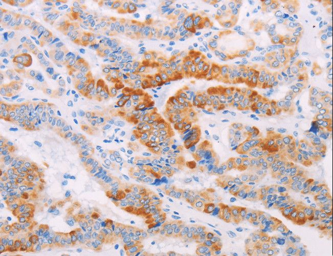 MAP4K3 / GLK Antibody - Immunohistochemistry of paraffin-embedded Human thyroid cancer using MAP4K3 Polyclonal Antibody at dilution of 1:30.