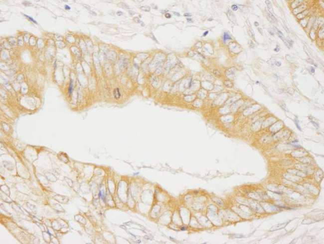 MAP4K4 Antibody - Detection of Human MAP4K4/HGK by Immunohistochemistry. Sample: FFPE section of human ovarian carcinoma. Antibody: Affinity purified rabbit anti-MAP4K4/HGK used at a dilution of 1:1000 (1 ug/ml). Detection: DAB.