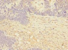MAP4K5 Antibody - Immunohistochemistry of paraffin-embedded human ovarian cancer at dilution 1:100