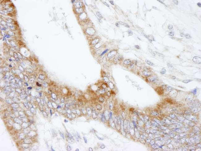 MAP7 Antibody - Detection of Human MAP7 by Immunohistochemistry. Sample: FFPE section of human colon carcinoma. Antibody: Affinity purified rabbit anti-MAP7 used at a dilution of 1:250.