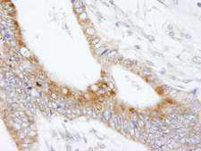 MAP7 Antibody - Detection of Human MAP7 by Immunohistochemistry. Sample: FFPE section of human colon carcinoma. Antibody: Affinity purified rabbit anti-MAP7 used at a dilution of 1:250.