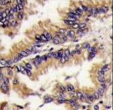 MAPK1 / ERK2 Antibody - Formalin-fixed and paraffin-embedded human lung carcinoma tissue reacted with MAPK1 Antibody , which was peroxidase-conjugated to the secondary antibody, followed by DAB staining. This data demonstrates the use of this antibody for immunohistochemistry; clinical relevance has not been evaluated.