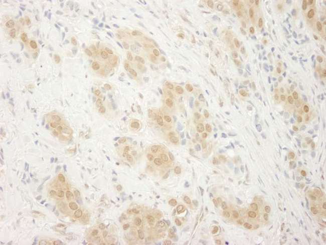 MAPK1 / ERK2 Antibody - Detection of Human ERK2 by Immunohistochemistry. Sample: FFPE section of human breast carcinoma. Antibody: Affinity purified rabbit anti-ERK2 used at a dilution of 1:250. Epitope Retrieval Buffer-High pH (IHC-101J) was substituted for Epitope Retrieval Buffer-Reduced pH.