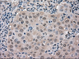 MAPK1 / ERK2 Antibody - IHC of paraffin-embedded Adenocarcinoma of breast tissue using anti-MAPK1 mouse monoclonal antibody. (Dilution 1:50).