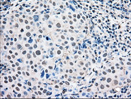 MAPK1 / ERK2 Antibody - IHC of paraffin-embedded Adenocarcinoma of breast tissue using anti-MAPK1 mouse monoclonal antibody. (Dilution 1:50).