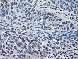 MAPK1 / ERK2 Antibody - IHC of paraffin-embedded Adenocarcinoma of ovary tissue using anti-MAPK1 mouse monoclonal antibody. (Dilution 1:50).